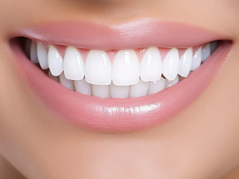 Hollywood Smile