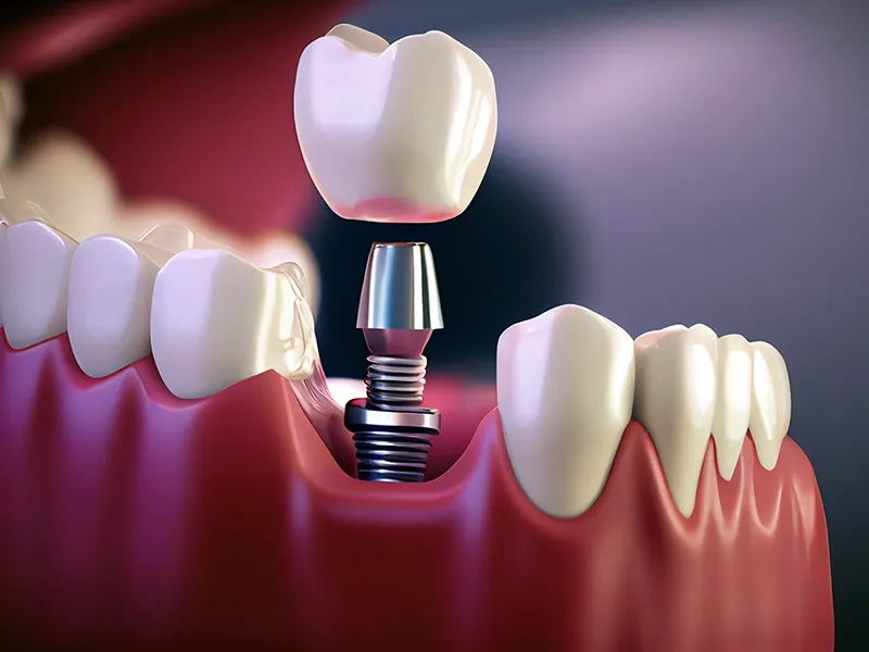 Diş İmplantları Nedir? Diş İmplantları Nedir?